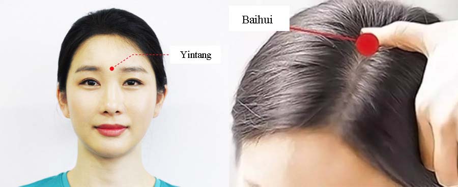 acupressure migraine 1